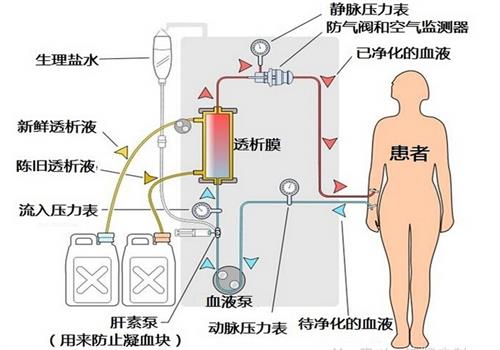 血液透析的原理